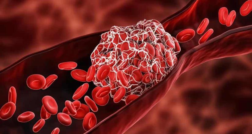 Primeras 4 horas, básicas en tratamiento de trombolisis