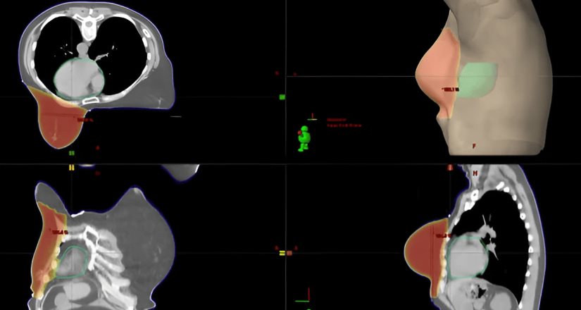 La puntuación de recurrencia del cáncer de mama predice los beneficios de la radioterapia