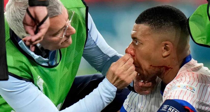 Tras fractura de nariz, Mbappe usará una máscara protectora 